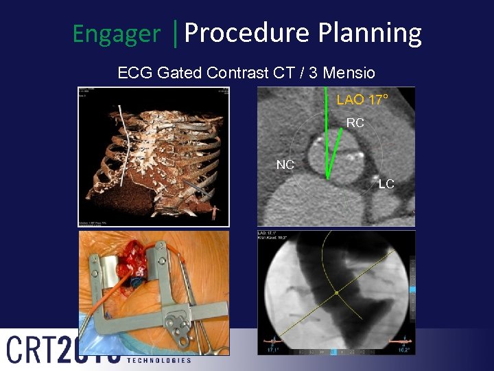 Engager │Procedure Planning ECG Gated Contrast CT / 3 Mensio LAO 17° RC NC