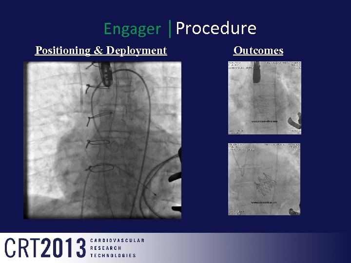 Engager │Procedure Positioning & Deployment Outcomes 