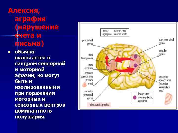 Алексия, аграфия (нарушение счета и письма) n обычно включается в синдром сенсорной и моторной