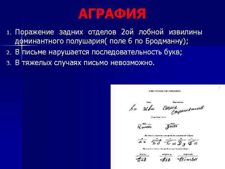 АГРАФИЯ 1. 2. 3. Поражение задних отделов 2 ой лобной извилины доминантного полушария( поле