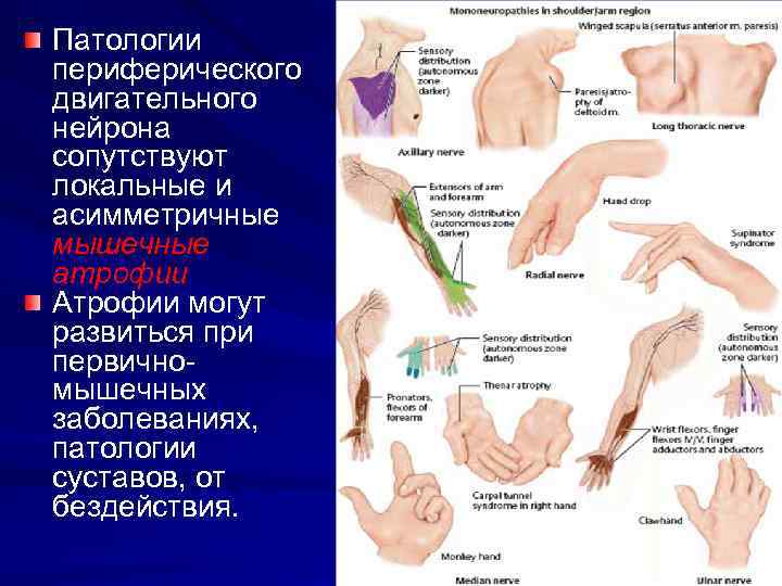Патологии периферического двигательного нейрона сопутствуют локальные и асимметричные мышечные атрофии Атрофии могут развиться при