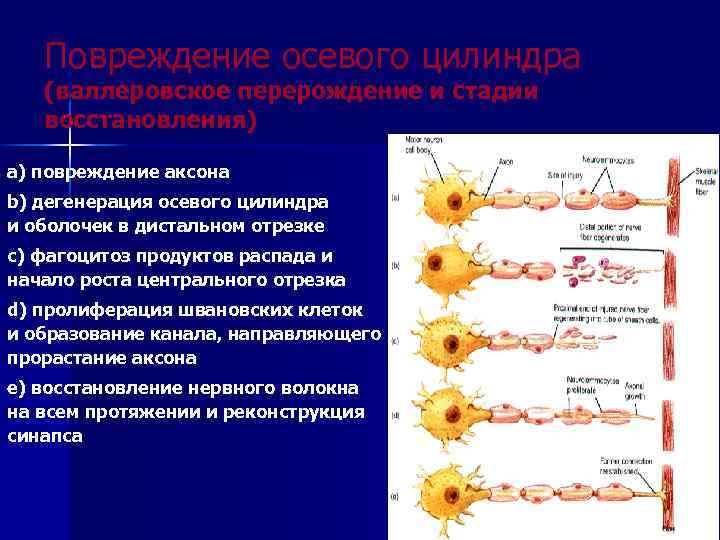 Повреждение осевого цилиндра (валлеровское перерождение и стадии восстановления) a) повреждение аксона b) дегенерация осевого