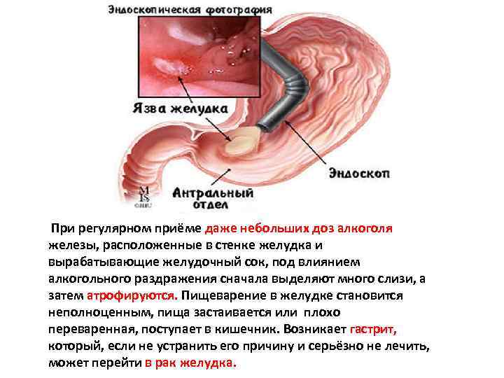 При регулярном приёме даже небольших доз алкоголя железы, расположенные в стенке желудка и вырабатывающие