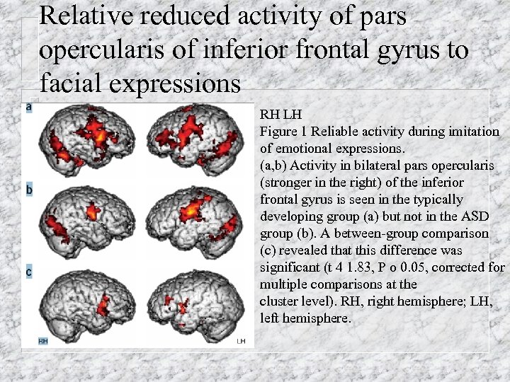 Relative reduced activity of pars opercularis of inferior frontal gyrus to facial expressions RH