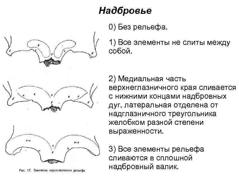 Надбровье 0) Без рельефа. 1) Все элементы не слиты между собой. 2) Медиальная часть