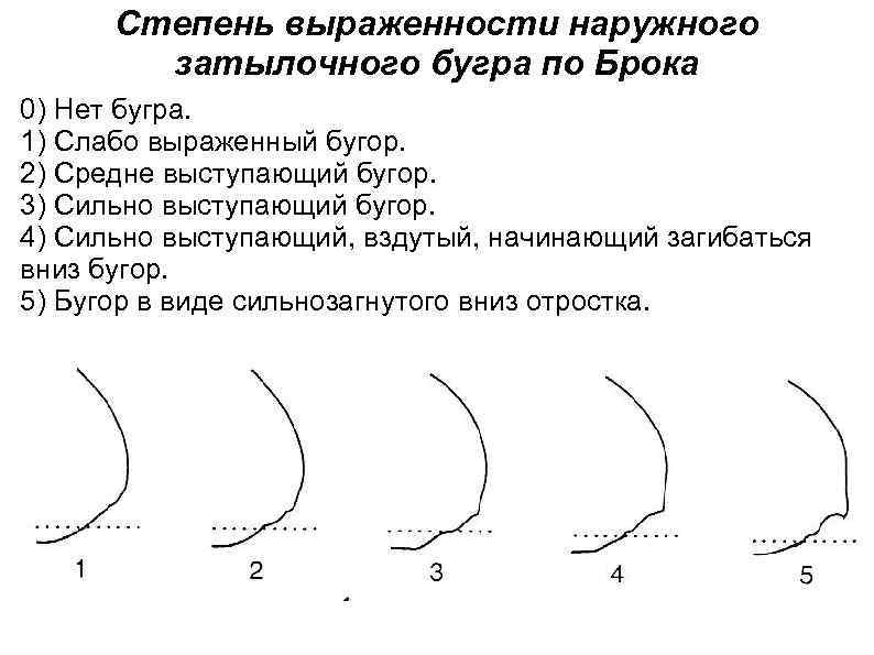 Степень выраженности наружного затылочного бугра по Брока 0) Нет бугра. 1) Слабо выраженный бугор.