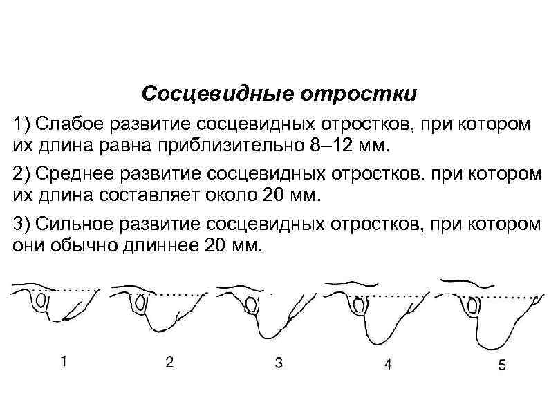 Сосцевидные отростки 1) Слабое развитие сосцевидных отростков, при котором их длина равна приблизительно 8–