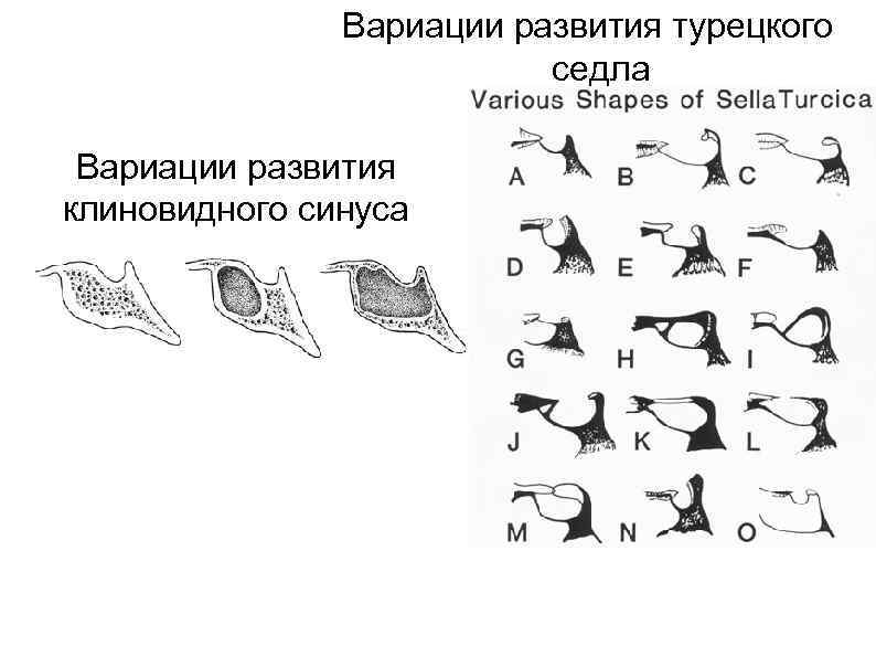 Передняя стенка турецкого седла