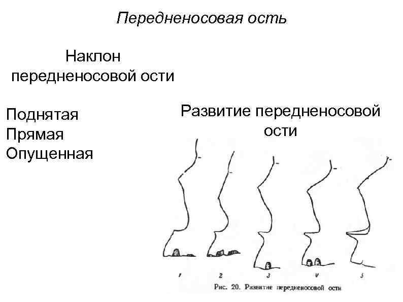 Передненосовая ость Наклон передненосовой ости Поднятая Прямая Опущенная Развитие передненосовой ости 
