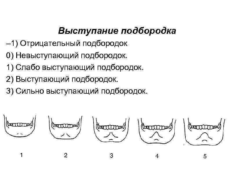 Выступание подбородка – 1) Отрицательный подбородок. 0) Невыступающий подбородок. 1) Слабо выступающий подбородок. 2)