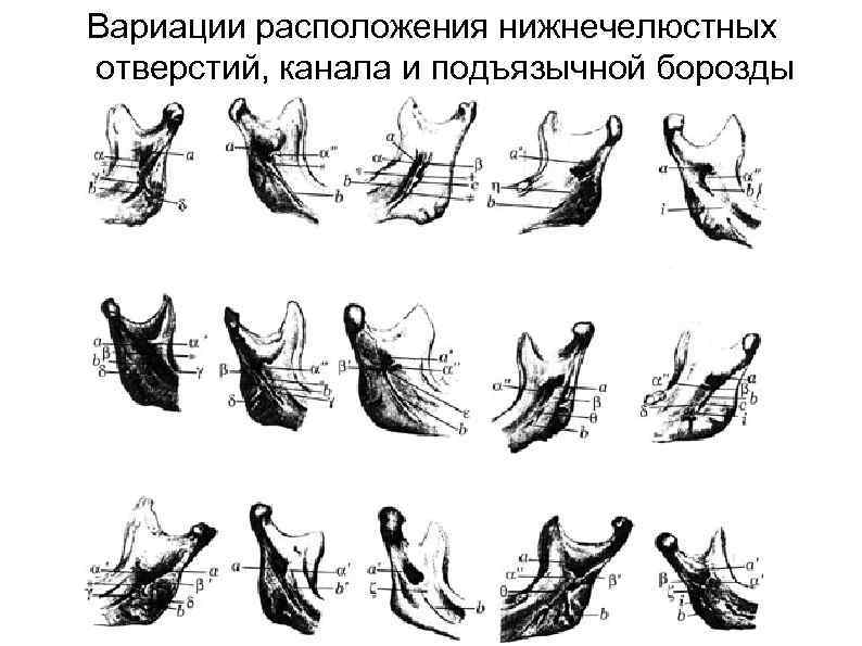 Вариации расположения нижнечелюстных отверстий, канала и подъязычной борозды 