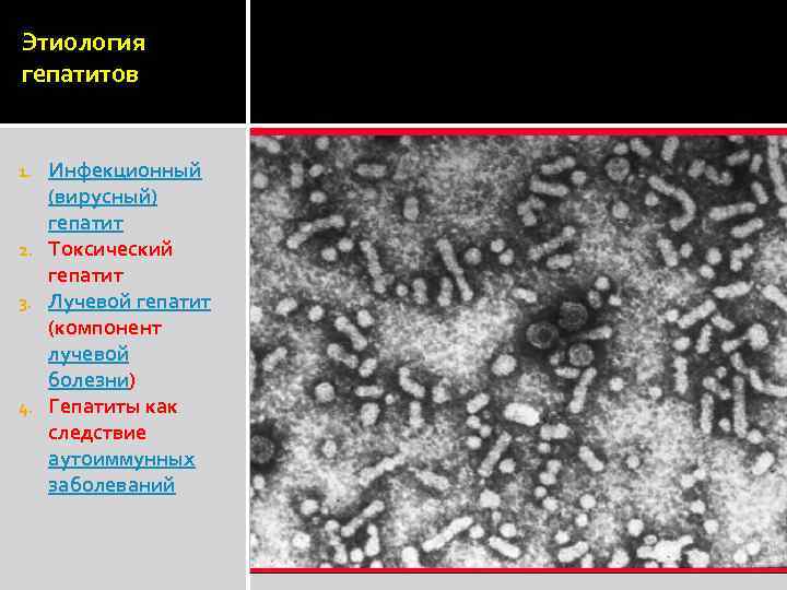 Этиология гепатитов Инфекционный (вирусный) гепатит 2. Токсический гепатит 3. Лучевой гепатит (компонент лучевой болезни)