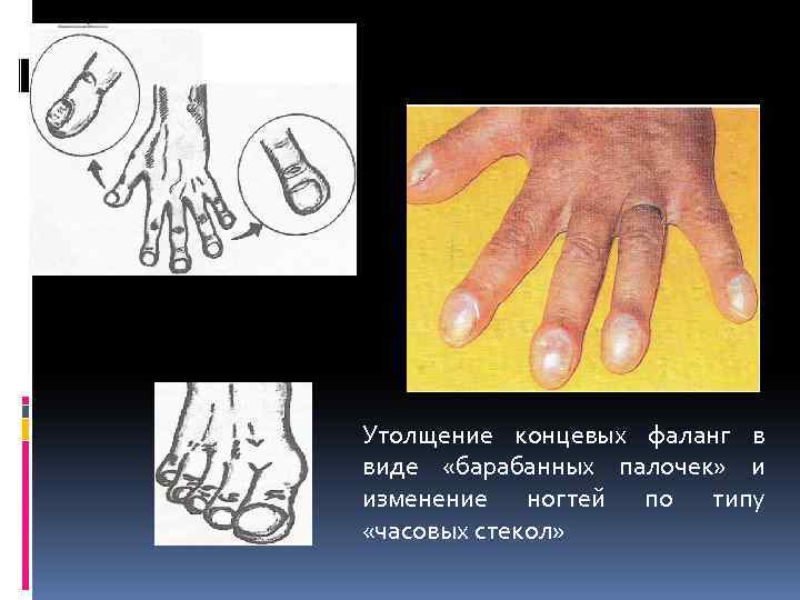 Утолщение концевых фаланг в виде «барабанных палочек» и изменение ногтей по типу «часовых стекол»