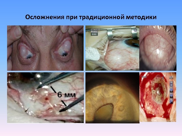 Осложнения при традиционной методики 
