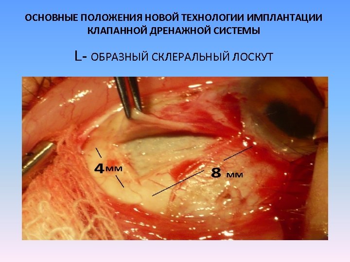 ОСНОВНЫЕ ПОЛОЖЕНИЯ НОВОЙ ТЕХНОЛОГИИ ИМПЛАНТАЦИИ КЛАПАННОЙ ДРЕНАЖНОЙ СИСТЕМЫ L- ОБРАЗНЫЙ СКЛЕРАЛЬНЫЙ ЛОСКУТ 