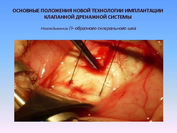 ОСНОВНЫЕ ПОЛОЖЕНИЯ НОВОЙ ТЕХНОЛОГИИ ИМПЛАНТАЦИИ КЛАПАННОЙ ДРЕНАЖНОЙ СИСТЕМЫ Накладывание П- образного склерального шва 