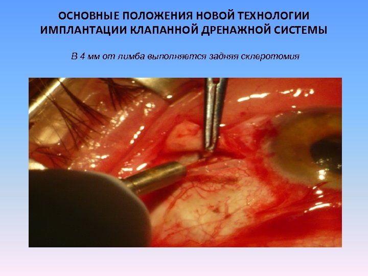 ОСНОВНЫЕ ПОЛОЖЕНИЯ НОВОЙ ТЕХНОЛОГИИ ИМПЛАНТАЦИИ КЛАПАННОЙ ДРЕНАЖНОЙ СИСТЕМЫ В 4 мм от лимба выполняется