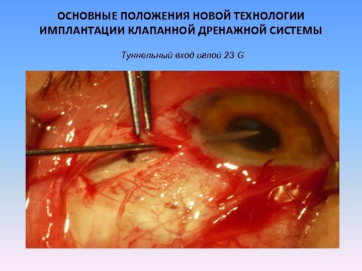 ОСНОВНЫЕ ПОЛОЖЕНИЯ НОВОЙ ТЕХНОЛОГИИ ИМПЛАНТАЦИИ КЛАПАННОЙ ДРЕНАЖНОЙ СИСТЕМЫ Туннельный вход иглой 23 G 