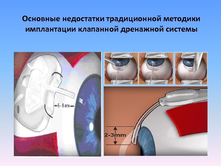 Основные недостатки традиционной методики имплантации клапанной дренажной системы 