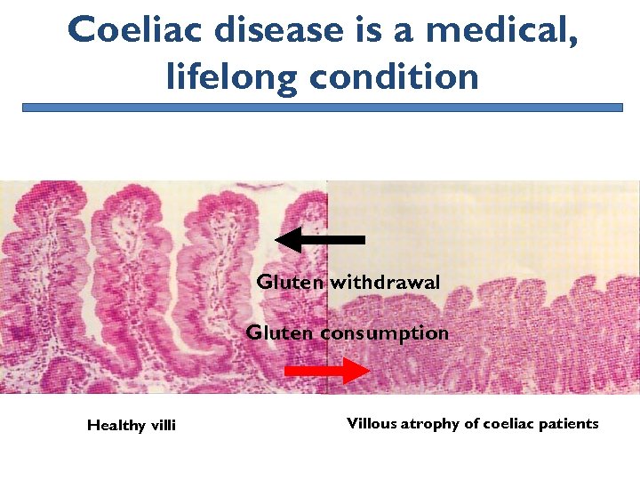 Coeliac disease is a medical, lifelong condition Gluten withdrawal Gluten consumption Healthy villi Villous