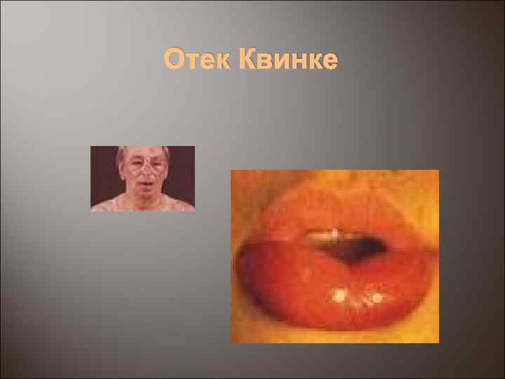 Отек Квинке 