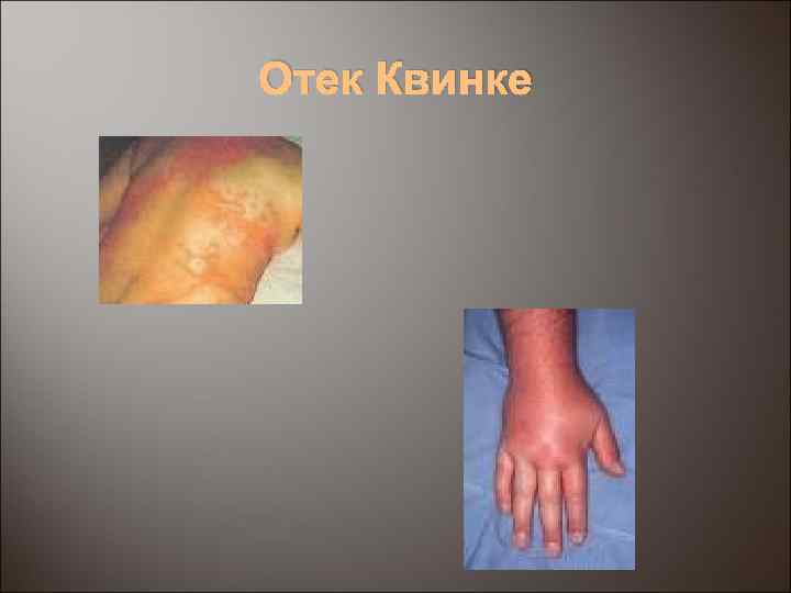 Отек Квинке 