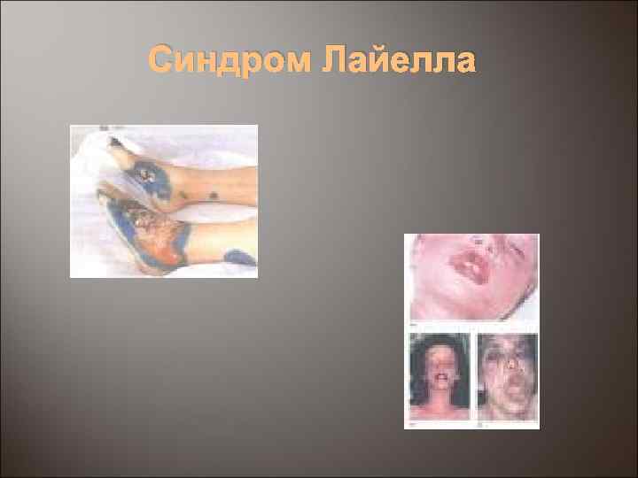 Синдром Лайелла 