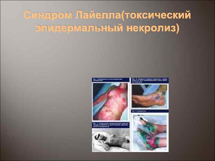Синдром Лайелла(токсический эпидермальный некролиз) 