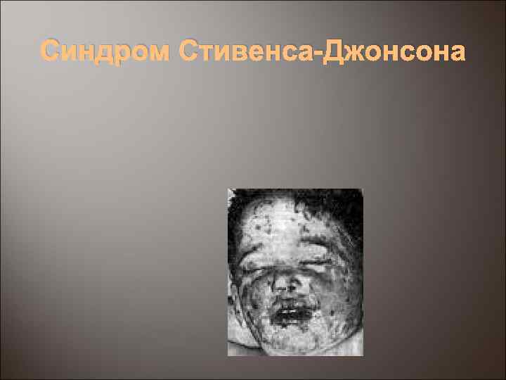 Синдром Стивенса-Джонсона 