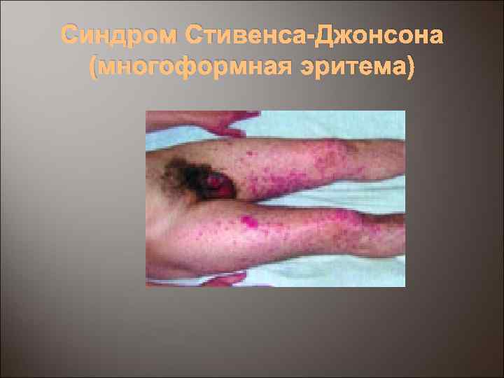 Синдром Стивенса-Джонсона (многоформная эритема) 