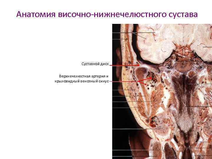 Анатомия височно-нижнечелюстного сустава Суставной диск Верхнечелюстная артерия и крыловидный венозный синус 