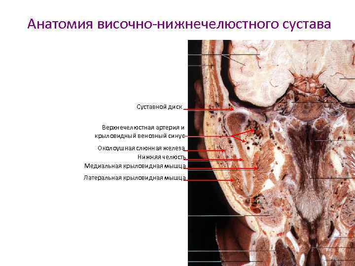 Анатомия височно-нижнечелюстного сустава Суставной диск Верхнечелюстная артерия и крыловидный венозный синус Околоушная слюнная железа