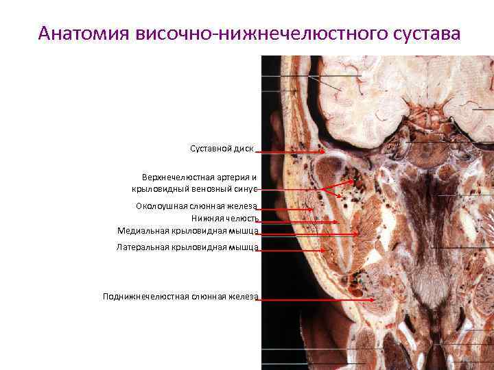 Анатомия височно-нижнечелюстного сустава Суставной диск Верхнечелюстная артерия и крыловидный венозный синус Околоушная слюнная железа