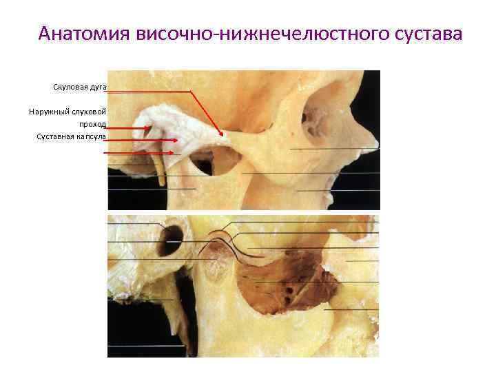 Анатомия височно-нижнечелюстного сустава Скуловая дуга Наружный слуховой проход Суставная капсула 