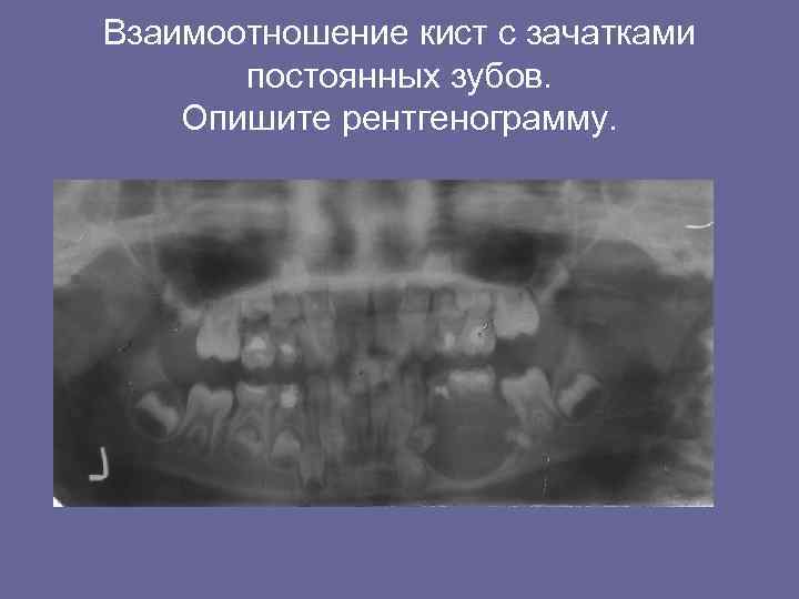 Зачатки это. Одонтогенные кисты челюстных костей. Зачатки постоянных зубов. Если нет зачатков постоянных зубов. Зачаток постоянного зуба.