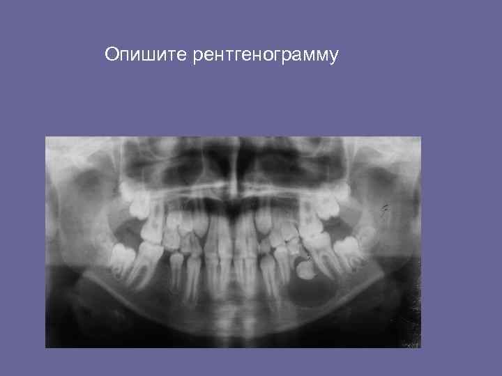 Опишите рентгенограмму 