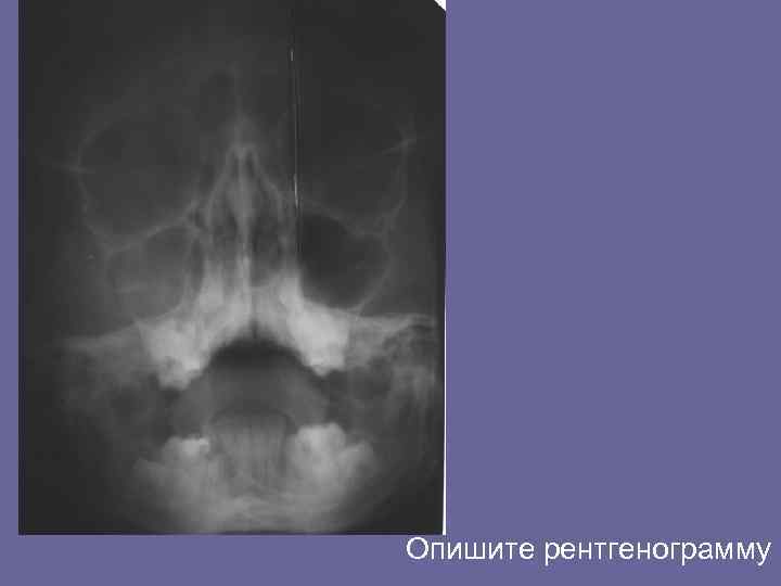 Опишите рентгенограмму 