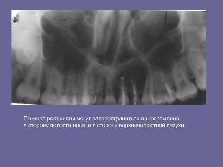По мере рост кисты могут распространяться одновременно в сторону полости носа и в сторону