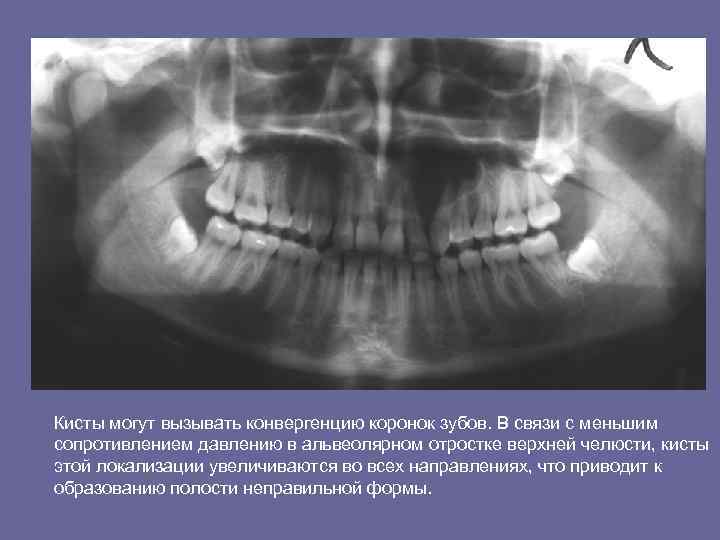 Кисты могут вызывать конвергенцию коронок зубов. В связи с меньшим сопротивлением давлению в альвеолярном