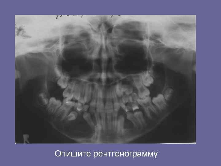 Опишите рентгенограмму 