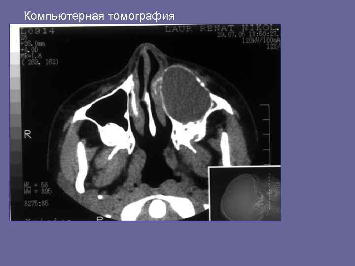 Компьютерная томография 