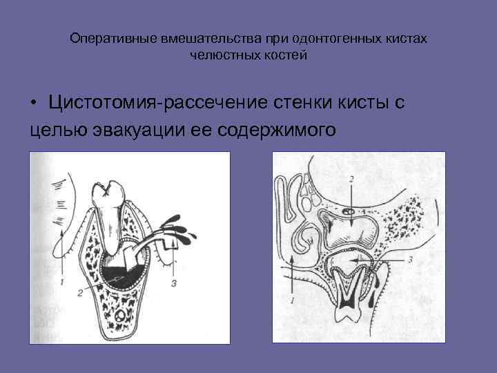 Оперативные вмешательства при одонтогенных кистах челюстных костей • Цистотомия-рассечение стенки кисты с целью эвакуации