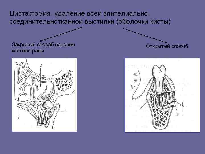 Цистэктомия