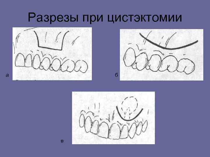 Разрезы при цистэктомии а б в 