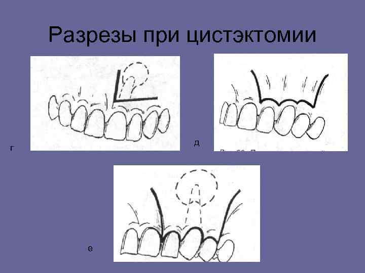 Разрезы при цистэктомии д г е 