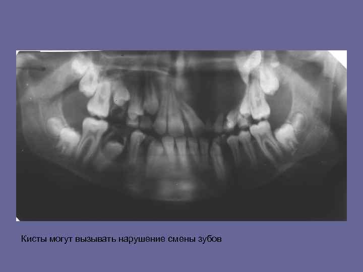 Кисты могут вызывать нарушение смены зубов 