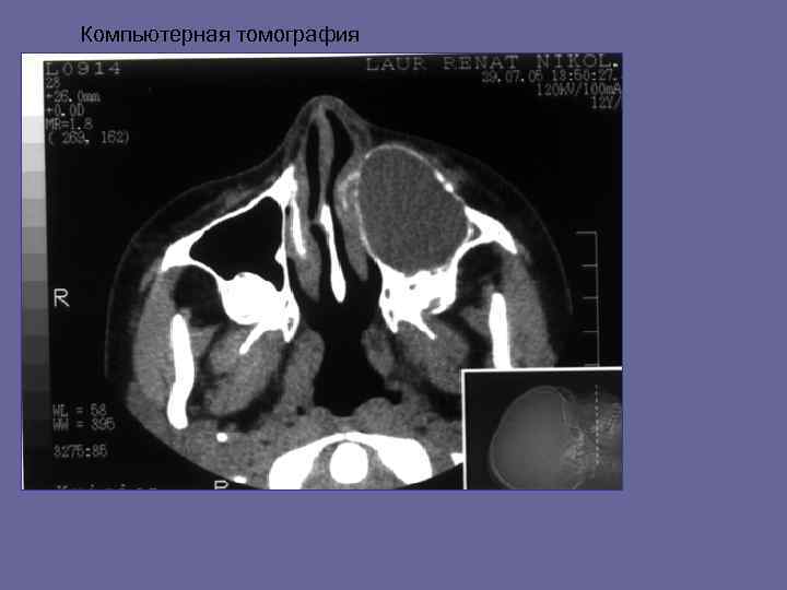 Компьютерная томография 