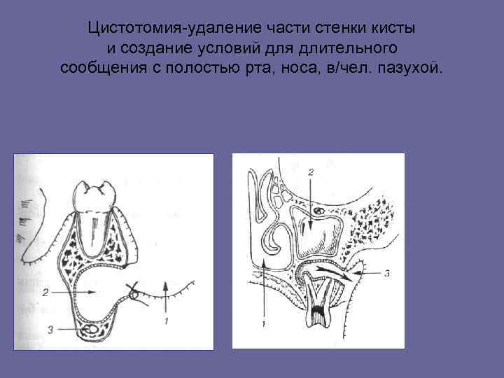 Цистотомия-удаление части стенки кисты и создание условий для длительного сообщения с полостью рта, носа,