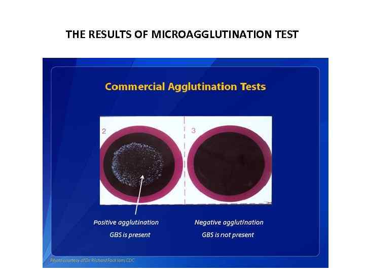 THE RESULTS OF MICROAGGLUTINATION TEST 