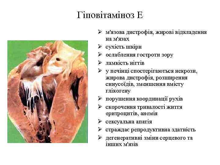 Гіповітаміноз Е Ø м'язова дистрофія, жирові відкладення на м'язах Ø сухість шкіри Ø ослаблення